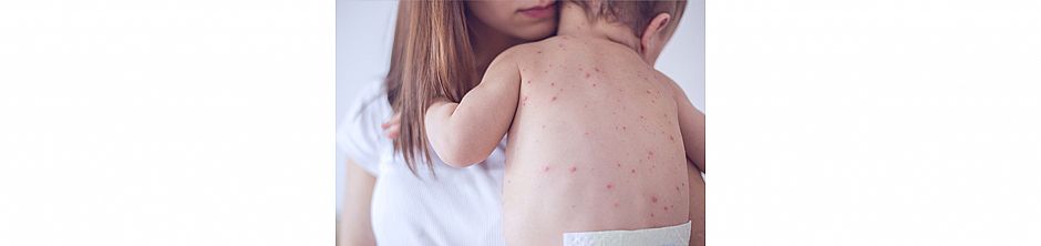 איך נגן על ילדינו מפני חצבת או במילים אחרות למה הורים שמחסנים את ילדיהם יכולים לישון טוב בלילה?